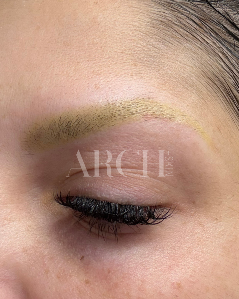 Before and after progression photos showing eyebrow density improvement over 6-month Revived Arch series in Dallas - sparse overplucked 90s brows showing fuller appearance after collagen induction therapy and LED treatment