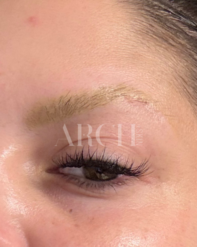 Before and after progression photos showing eyebrow density improvement over 6-month Revived Arch series in Dallas - sparse overplucked 90s brows showing fuller appearance after collagen induction therapy and LED treatment