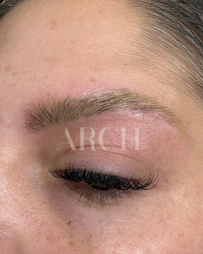 Before and after progression photos showing eyebrow density improvement over 6-month Revived Arch series in Dallas - sparse overplucked 90s brows showing fuller appearance after collagen induction therapy and LED treatment