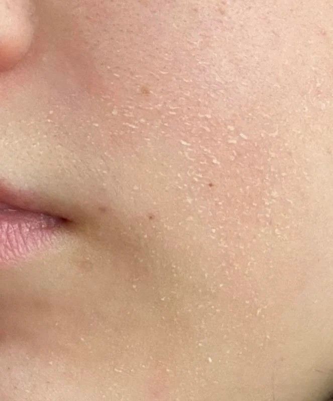 compromised skin barrier signs redness dryness sensitivity