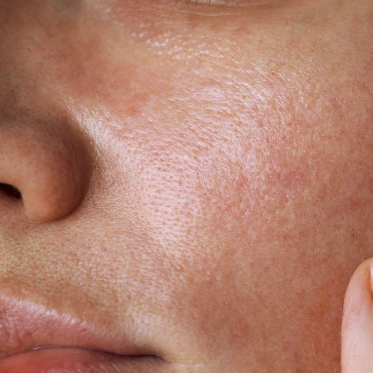 compromised skin barrier signs redness dryness sensitivity